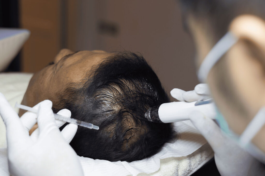 Microneedeling-RF-baru