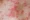 scabies